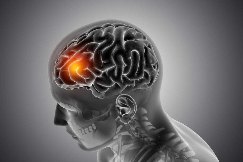 Tratamiento de la Enfermedad Cerebrovascular de Origen Carotídeo: Prevención de Derrames Cerebrales