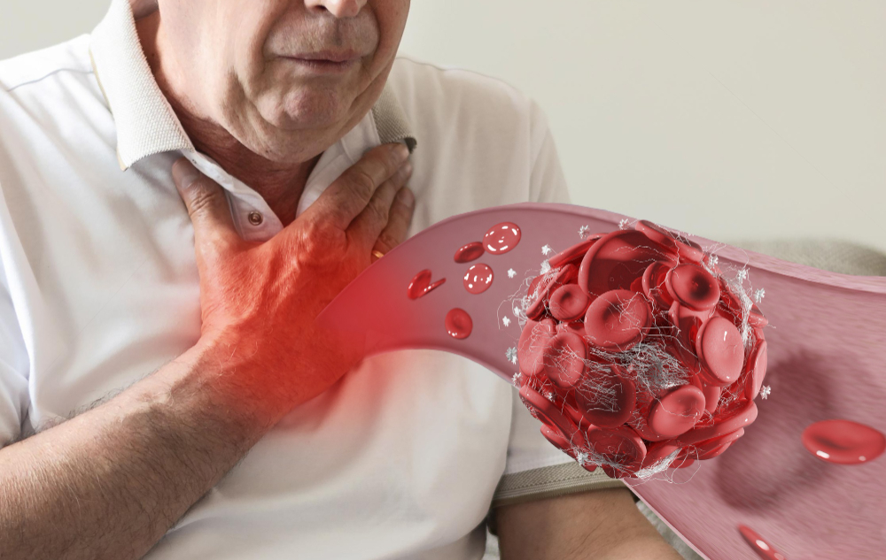 Exclusión de Aneurisma de Aorta: Procedimiento Vital para Prevenir la Ruptura Aneurismática