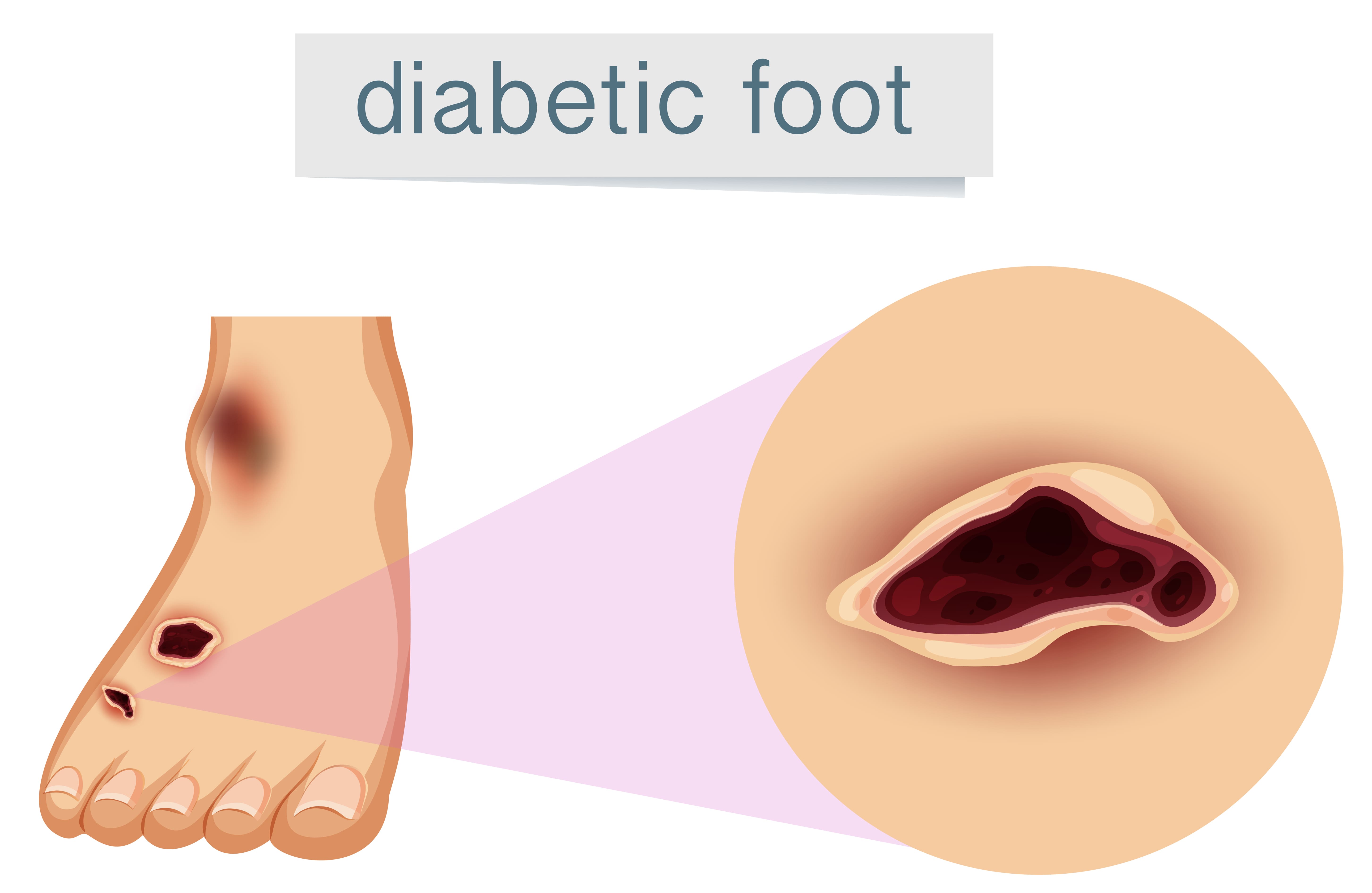Tratamiento para Pie Diabético: Cuidando Tus Pies para Evitar Complicaciones